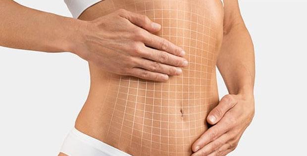Abdominoplastie cicatrice