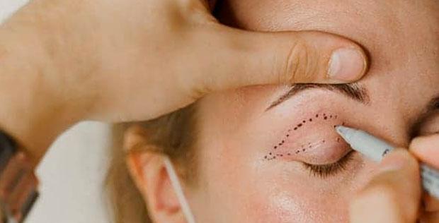Cicatrice après une blépharoplastie