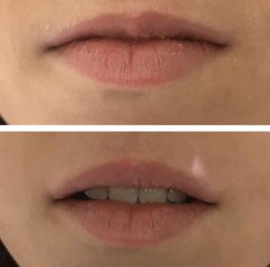 Acide hyaluronique - Patiente 1