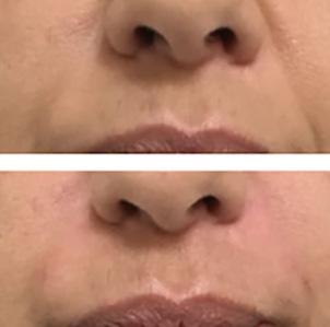 Acide hyaluronique - avant/apr&egrave;s