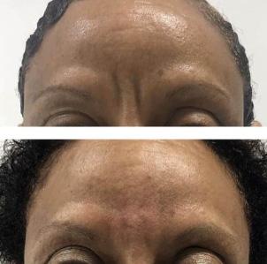 acide hyaluronique - avant/apr&egrave;s