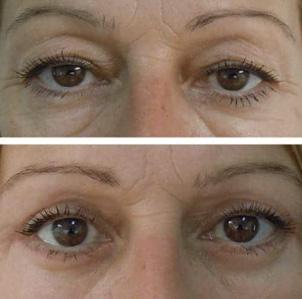 Bl&eacute;pharoplastie - Patient 1