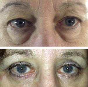 Bl&eacute;pharoplastie - Patient 1
