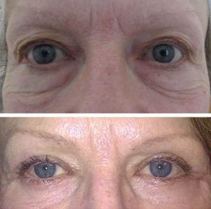 Bl&eacute;pharoplastie - Patient 3