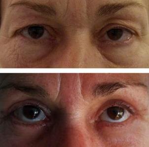 Bl&eacute;pharoplastie - Patient 4
