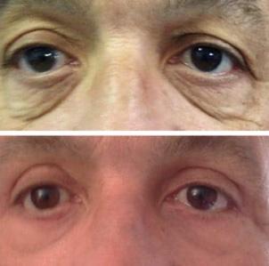 Bl&eacute;pharoplastie - Patient 5