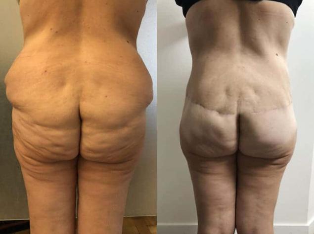 Bodylift - Patiente 1 dos