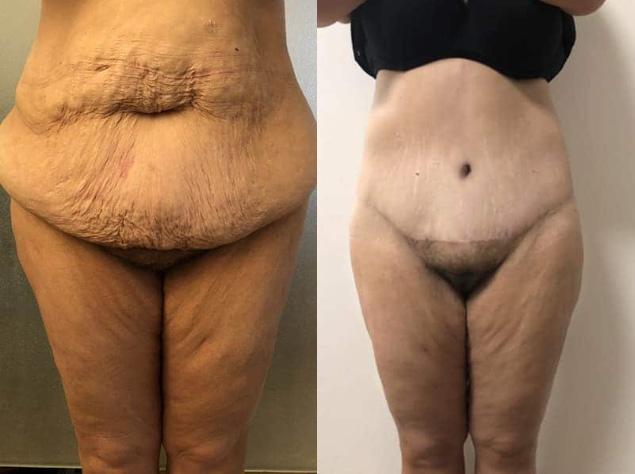 Bodylift - Patiente 1 face