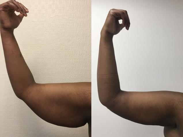 Brachioplastie / lifting des bras - Patiente 1