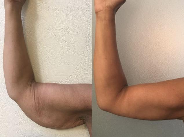 Brachioplastie / lifting des bras - Patiente 2