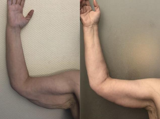 Brachioplastie / lifting des bras - Patiente 3