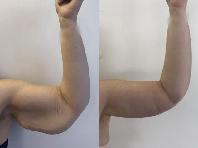 Brachioplastie / lifting des bras - Patiente 4