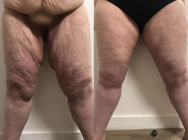 Cruroplastie - Patiente 2