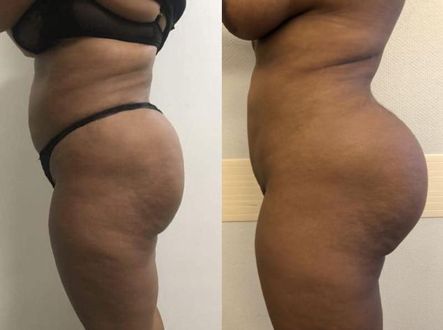 Implants fessiers - Patiente 1