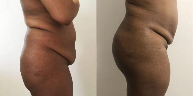 Lipofilling fessier - Patiente 1 profil