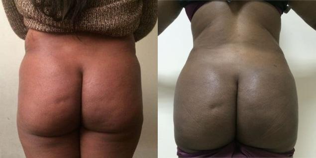 Lipofilling fessier - Patiente 1 dos