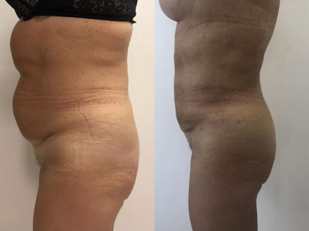 Liposuccion - Patiente 1