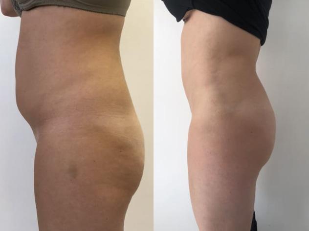 Liposuccion - Patiente 2