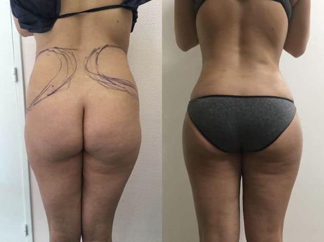 Liposuccion - Patiente 3
