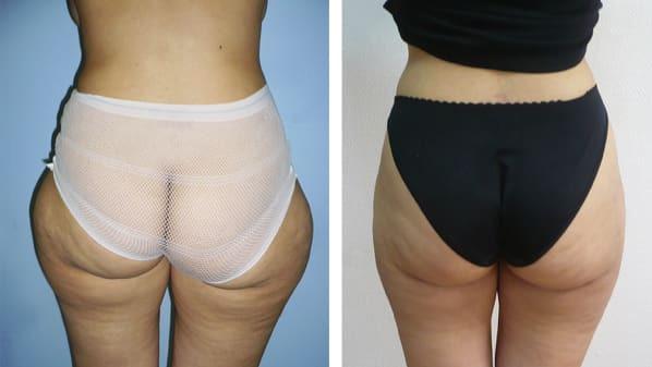 Liposuccion - Patiente 4