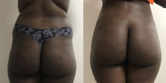 Liposuccion - Patiente 5