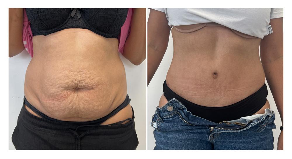 Abdominoplastie avant/apr&egrave;s