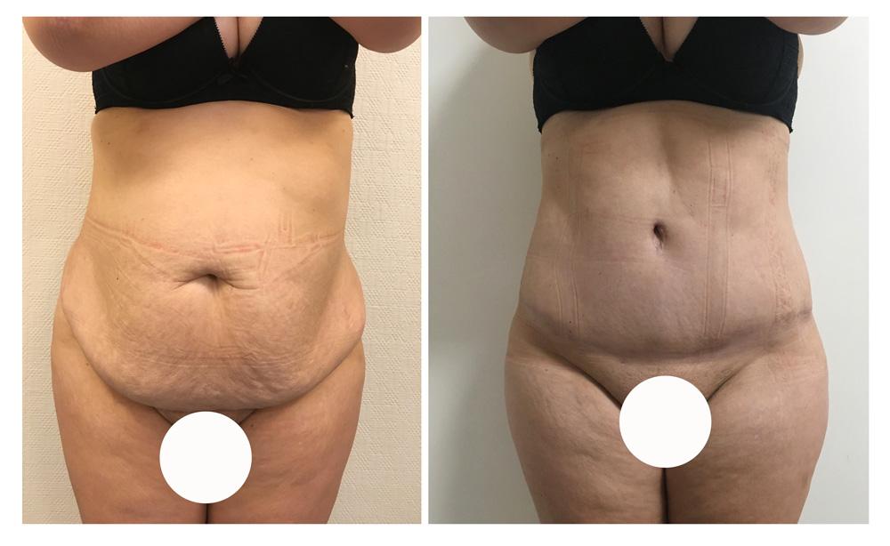 Abdominoplastie avant/apr&egrave;s