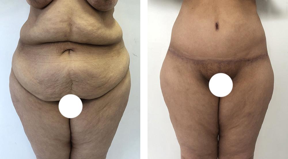 Abdominoplastie avant/apr&egrave;s