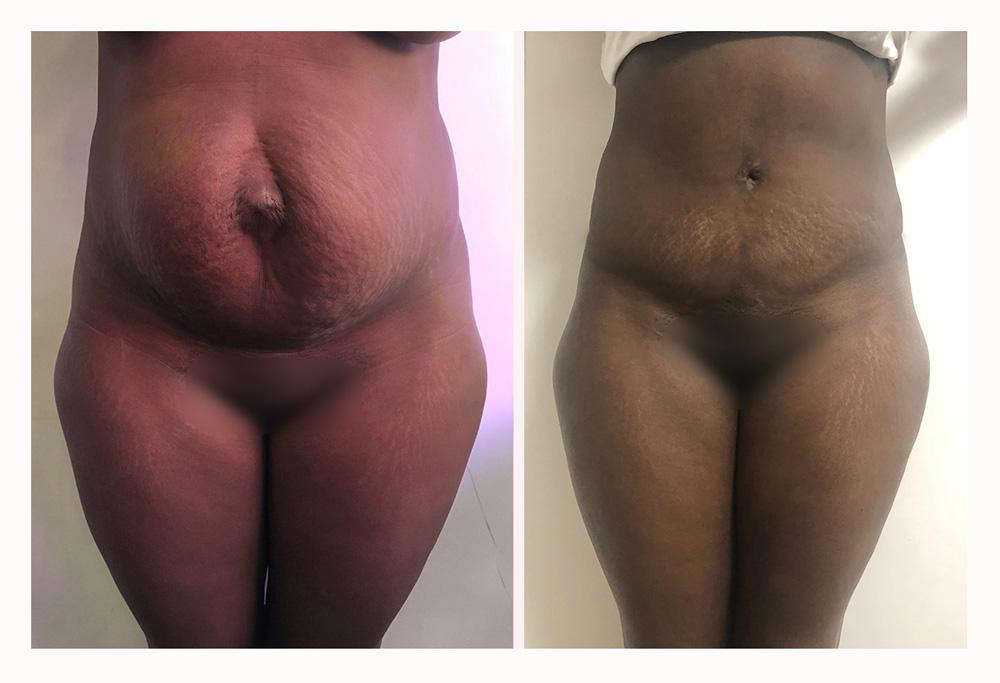 Abdominoplastie avant/apr&egrave;s