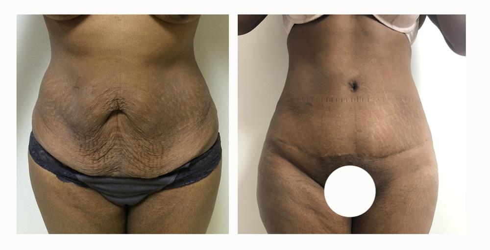Abdominoplastie avant/apr&egrave;s