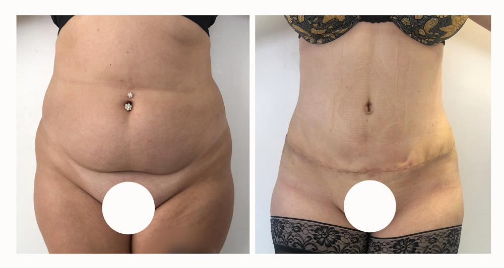 Abdominoplastie avant/apr&egrave;s
