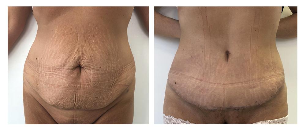 Abdominoplastie - Patiente 15