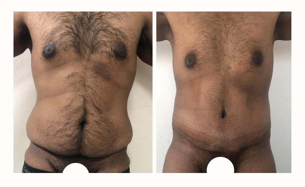 Abdominoplastie - Patiente 17