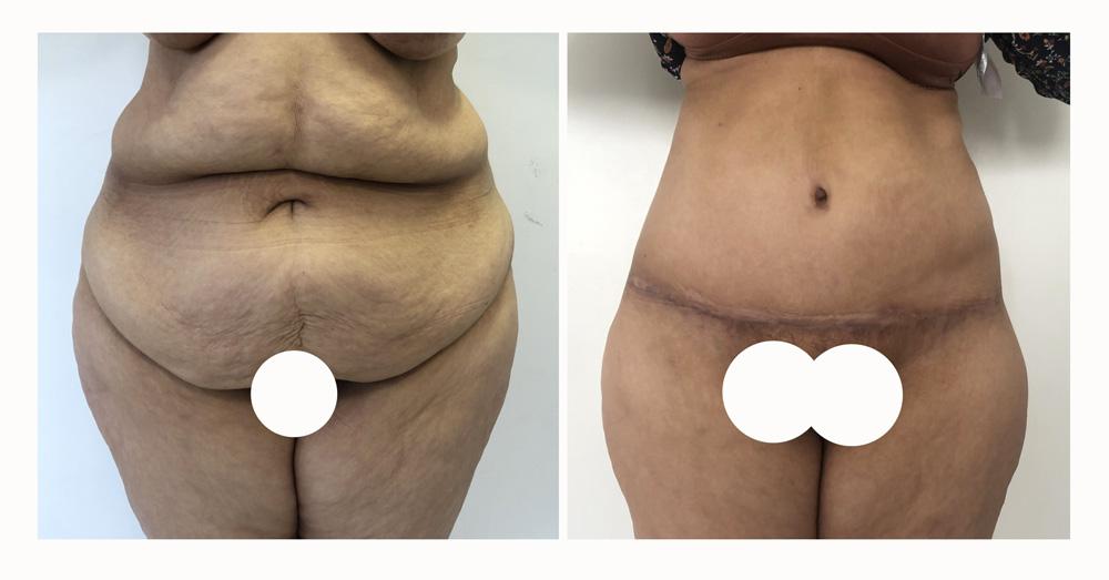 Abdominoplastie - Patiente 18