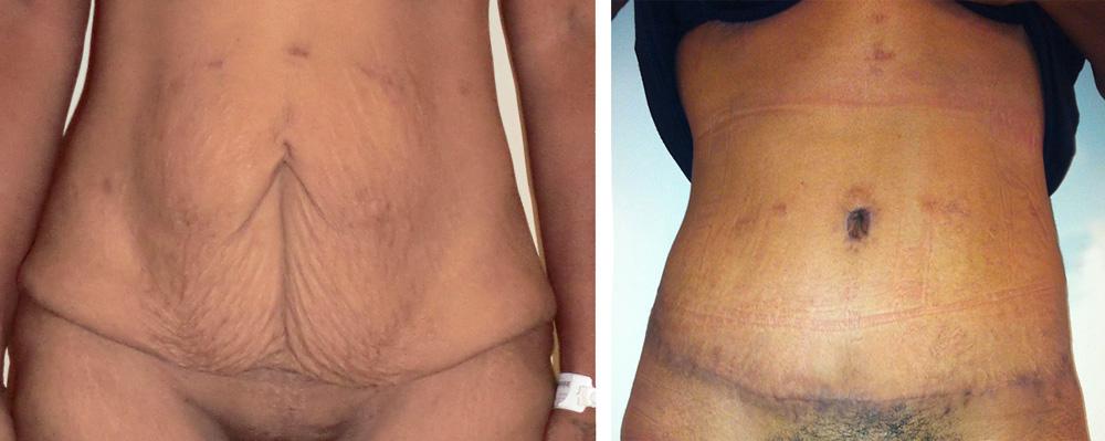 Abdominoplastie - Patiente 19