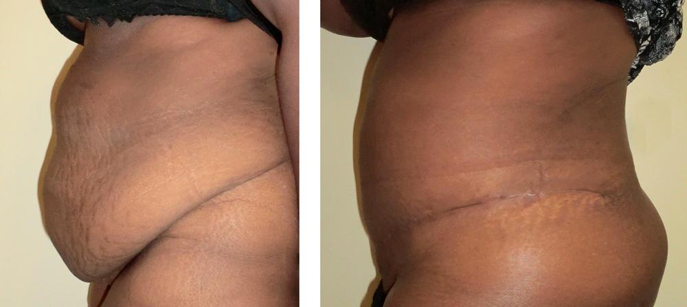 Abdominoplastie - Patiente 20