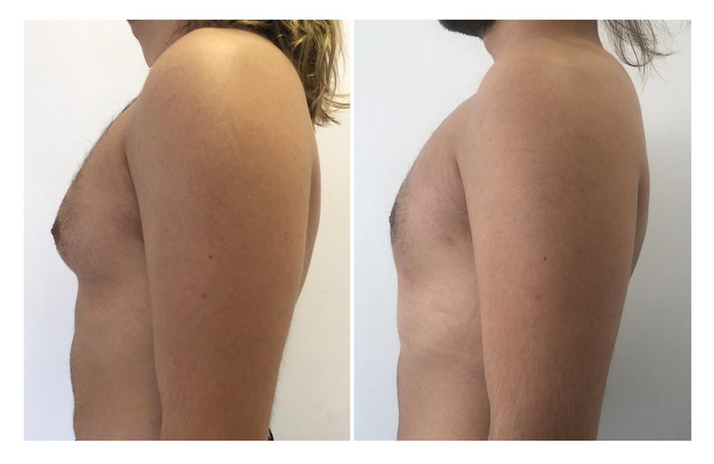 Gyn&eacute;comastie - Patient 1