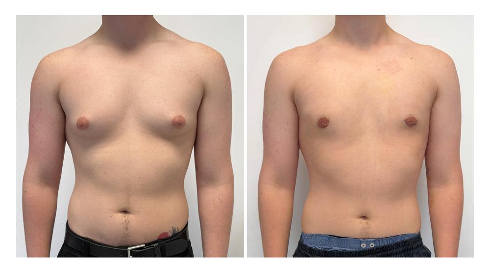 Gyn&eacute;comastie - Patient 2