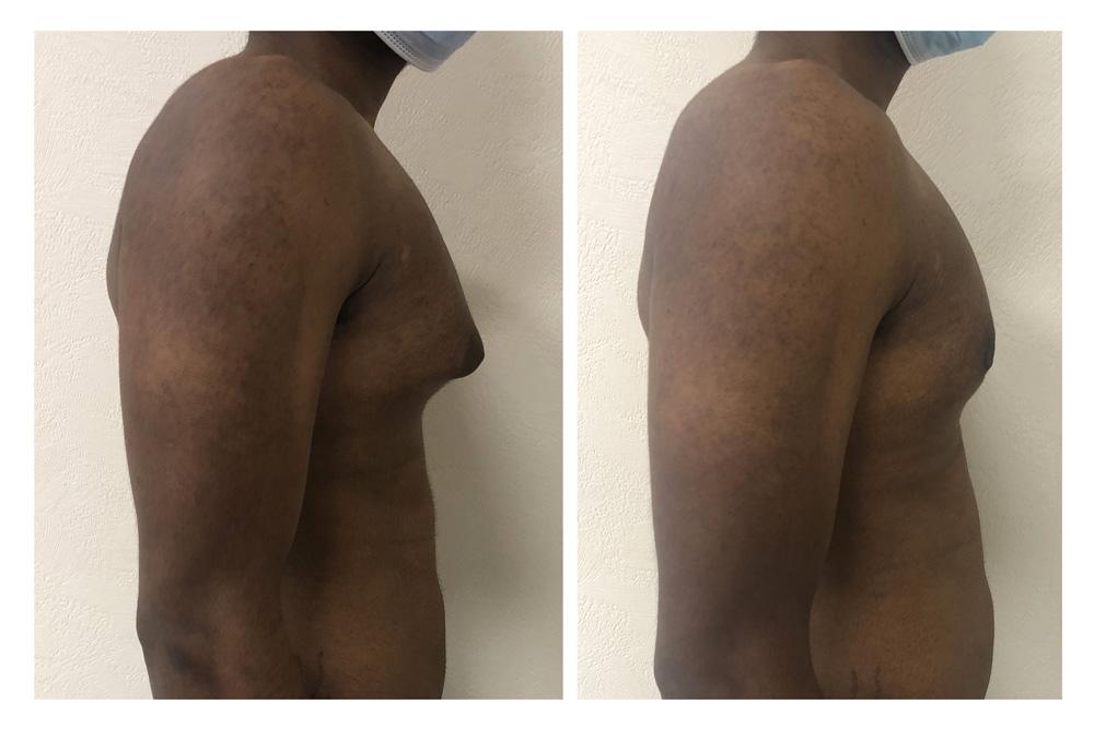 Gyn&eacute;comastie - Patient 4