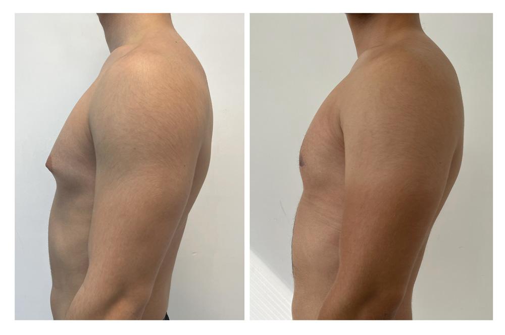 Gyn&eacute;comastie - Patient 7