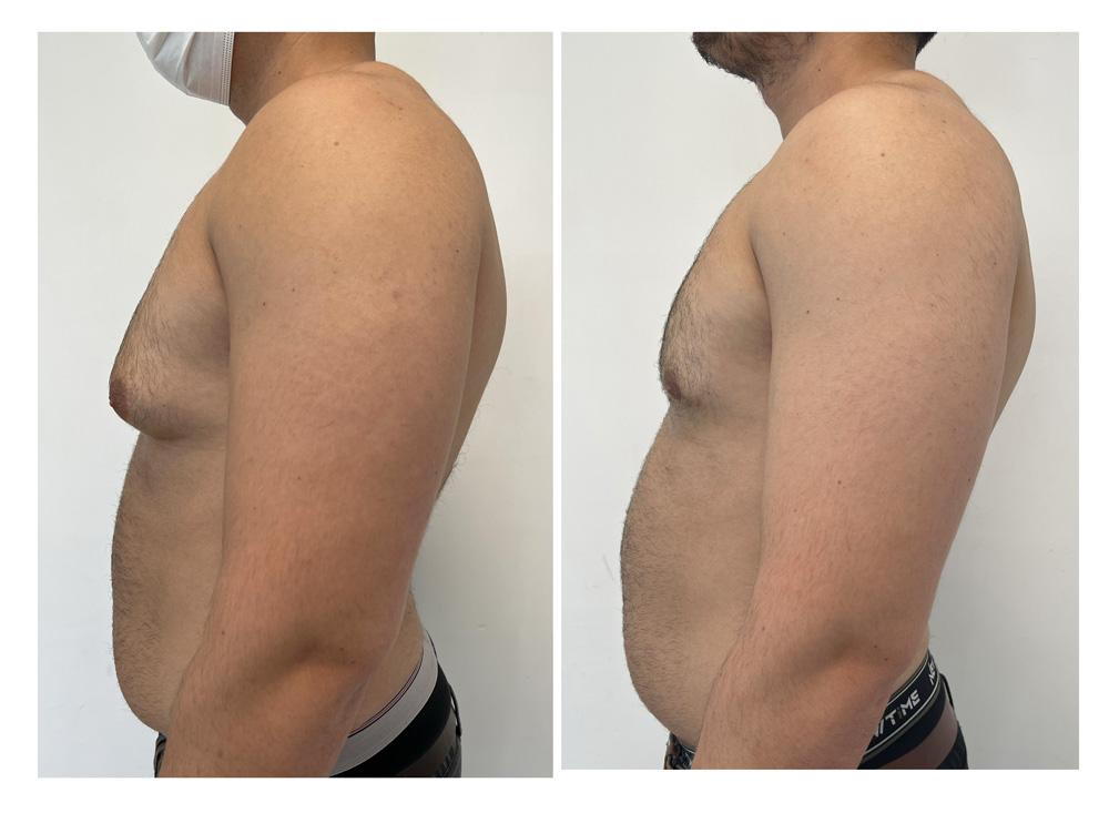 Gyn&eacute;comastie - Patient 8