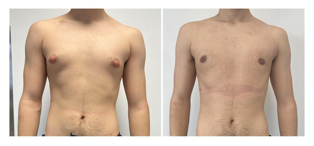 Gyn&eacute;comastie - Patient 10