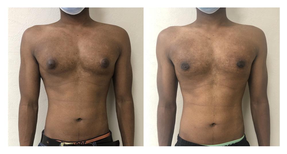 Gyn&eacute;comastie - Patient 11