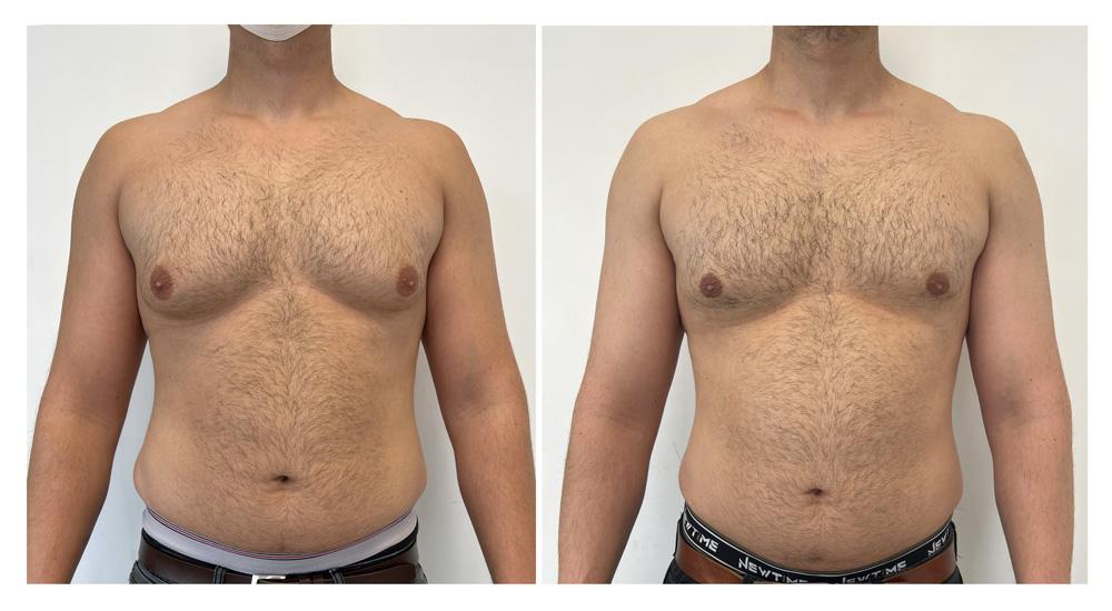 Gyn&eacute;comastie - Patient 12