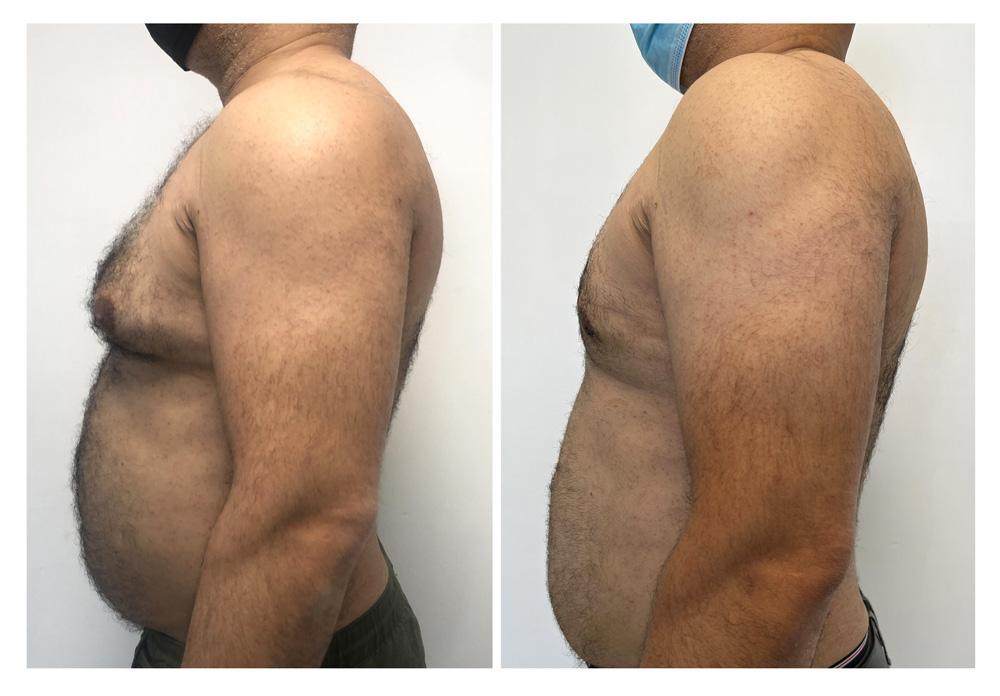 Gyn&eacute;comastie - Patient 14