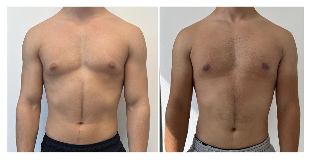 Gyn&eacute;comastie - Patient 15