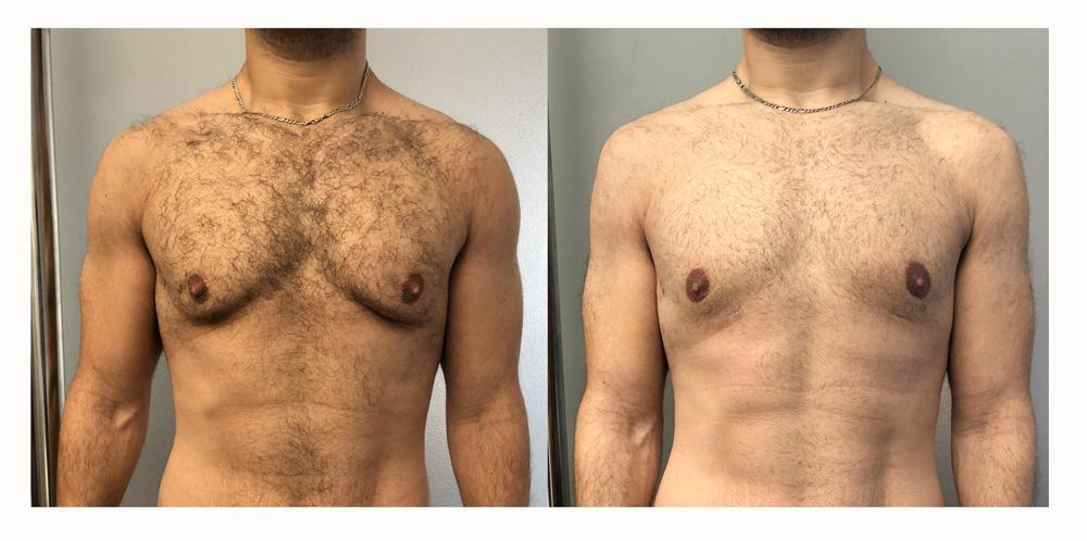 Gyn&eacute;comastie - Patient 16