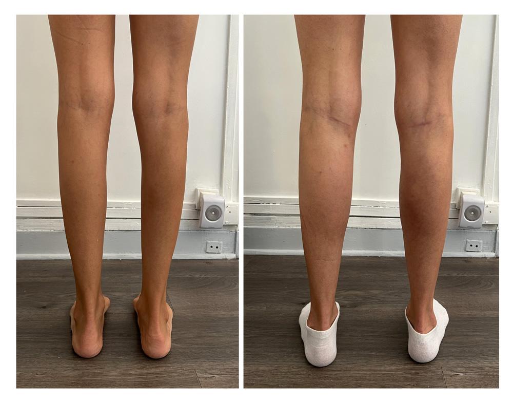 Augmentation du mollet - Patient 02