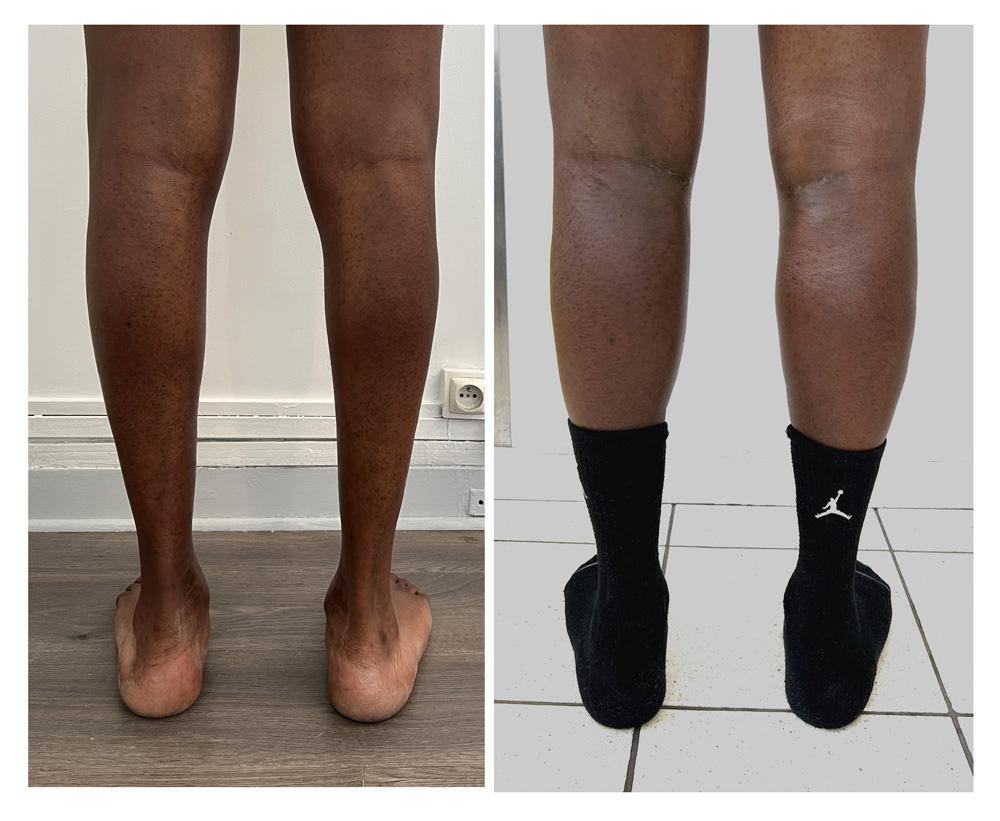 Augmentation du mollet - Patient 03