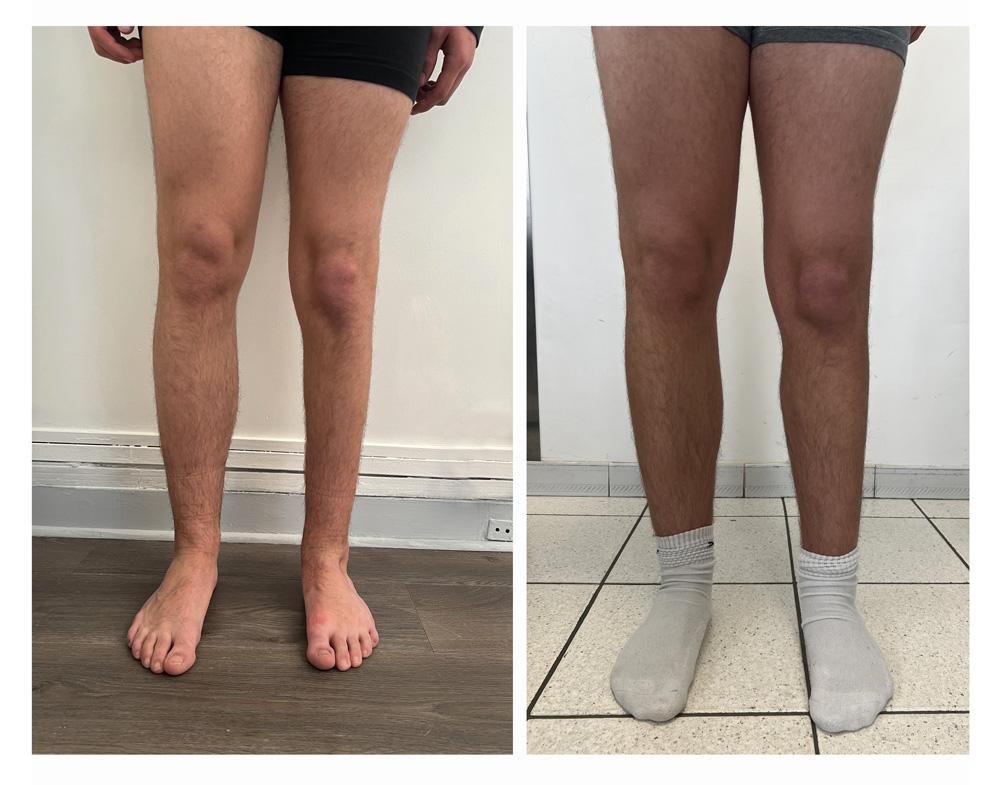 Augmentation du mollet - Patient 04